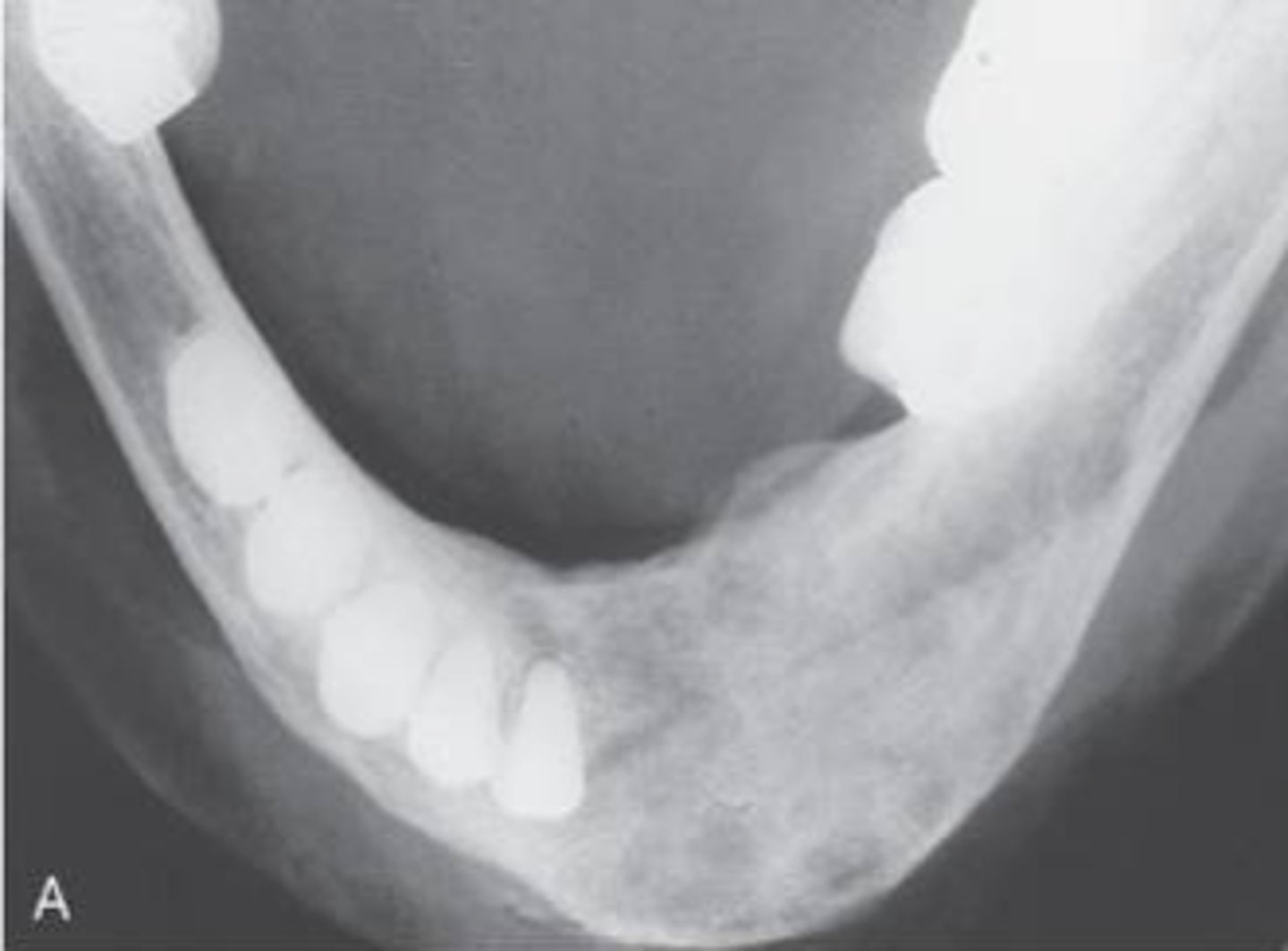 <p>-results from excessive secretion of parathyroid hormone (parathormone)</p>