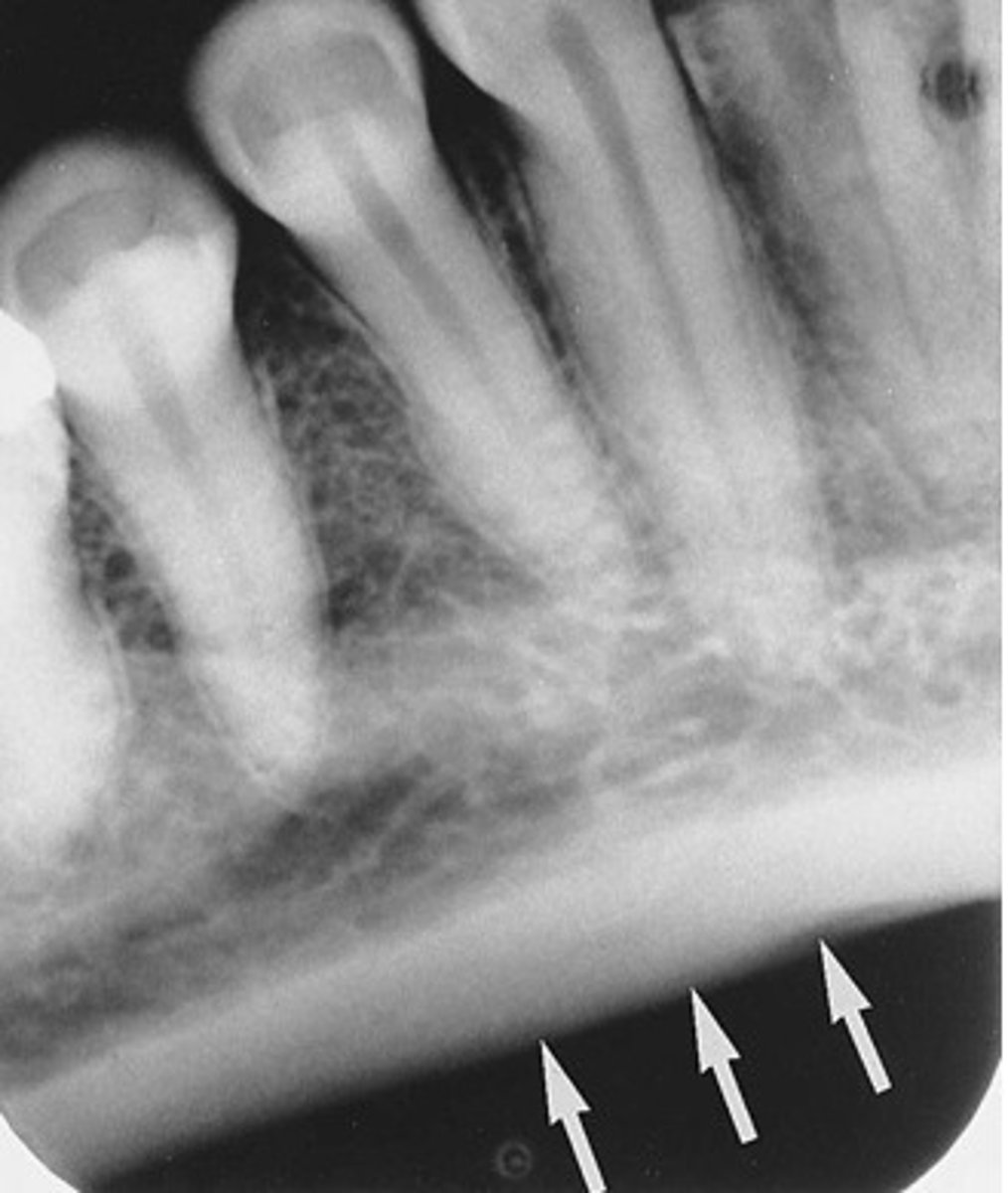 <p>rounded edge/border of the mandible</p>