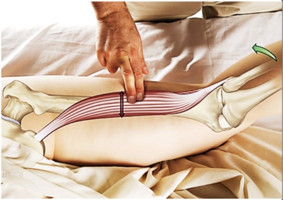 <p>bicep femoris</p>