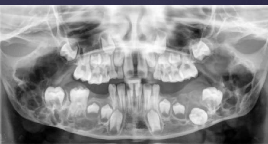 <ol><li><p>bilateral multilocular radiolucencies</p></li><li><p>multicystic appearance</p></li><li><p>expansion/thinning of cortices</p></li><li><p>uncommon perforation</p></li><li><p>tooth displacement, resorption</p></li></ol><p></p>