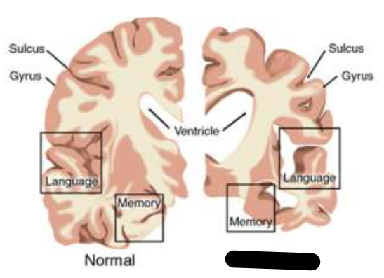 <p>What disease caused the right portion?</p>