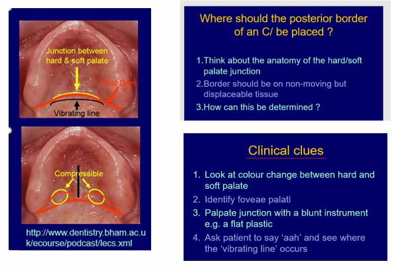 <p>Mark the post dam area</p><p>border should be on non-moving but displaceable tissues</p><ul><li><p>look at the colour change between hard and soft palate</p></li><li><p>identify fovea palati</p></li><li><p>palpate junction with a blunt instrument&nbsp;</p></li><li><p>ask patient to say ahhh and see where the vibrating line occurs&nbsp;</p></li></ul><p></p>