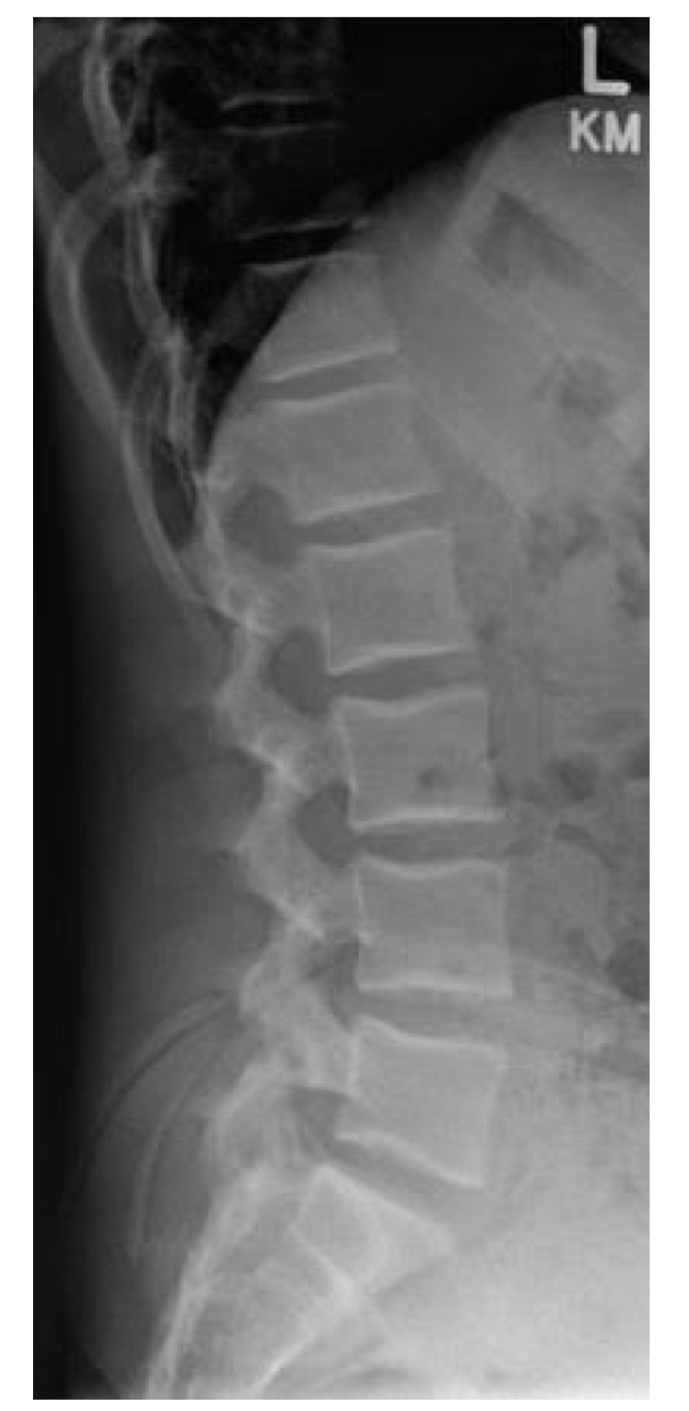 <ul><li><p>T12 tom. S1</p></li><li><p>Foramen intervertebralis fra L1-L4 skal fremstilles. </p></li><li><p>Corpus, intervertebralleddene, pediklene og processus spinosus. </p></li><li><p>Åpne leddspalter mellom virvlene - ryggraden er justeert paralleelt med detektoren. </p></li></ul>