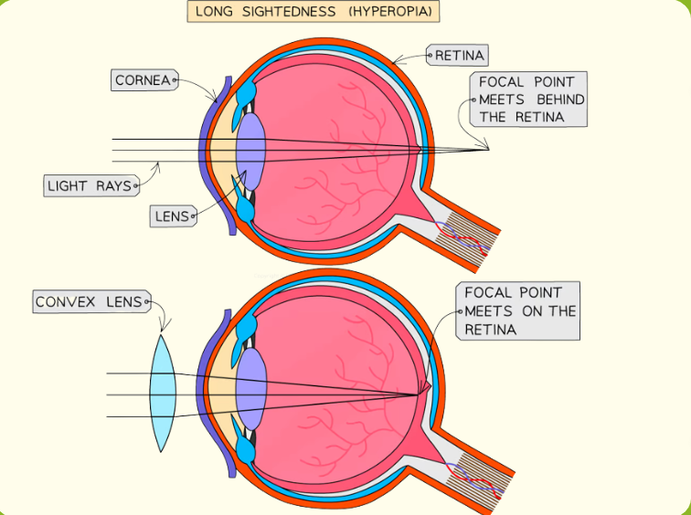 <p>It is caused by:</p><p>the eyeball being too short - so the distance between the lens and retina is too small</p><p>a loss of elasticity in the lens - meaning it cannot become thick enough to focus (which is often age-related)</p><p>&lt;- It can be corrected by convex</p>