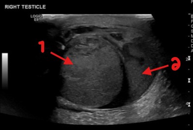 <p>A patient has experienced trauma to the scrotum recently and this image was obtained. What can be assumed here for arrows 1 and 2?</p>