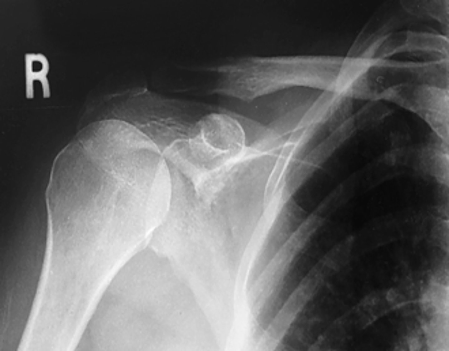 <p>- CR to scapulohumeral joint (¾ inch inferior and slightly lateral to coracoid process)</p><p>- Greater tubercle superimposed</p><p>- Scapulohumeral joint centered</p><p>- Optimal exposure factors</p>