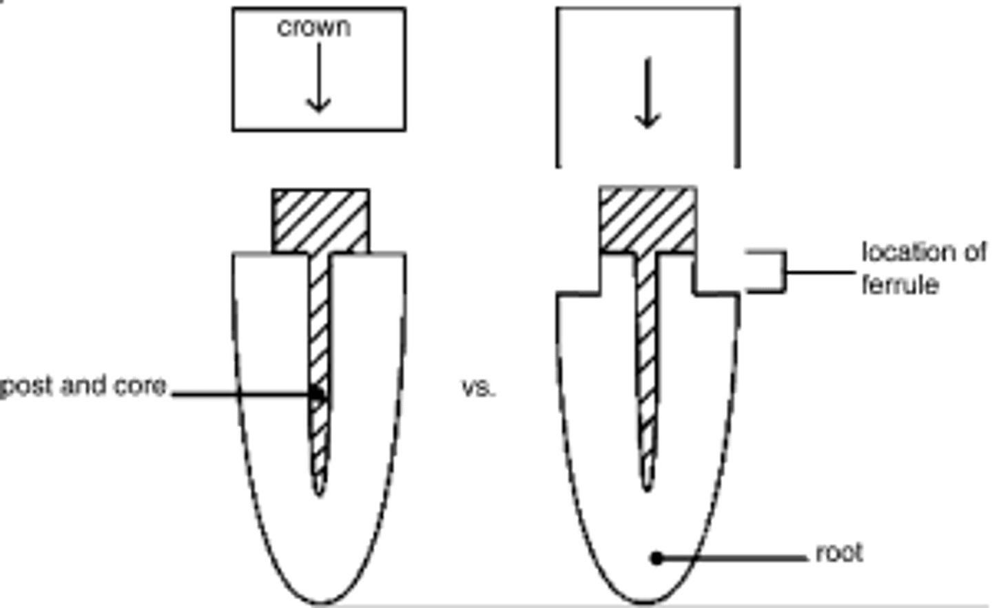<p>Define the following:</p><ul><li><p>Band of restoration that encircles the external dimension of residual tooth structure (part of the crown that braces the tooth to provide resistance to dislodgement and prevent fracture)</p></li><li><p>2mm vertical band of healthy, natural tooth structure above gum line that crown embarces to improve stability, prevent root fracture, and increase longevity of ETT</p></li></ul><p></p>