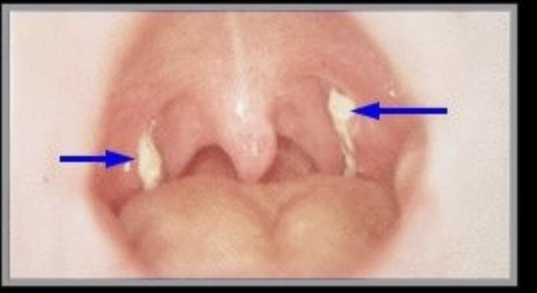 <p>from upper respiratory tract, humans only host. transmitted through inhalation. cytotoxic exotoxin blocks protein synthesis, enters blood &amp; damages heart &amp; CNS. if toxin not present, strain is not pathogenic. initial symptoms are sore throat, fever, &amp; malaise. pseudomembrane forms in throat. myocarditis, suffocation</p>