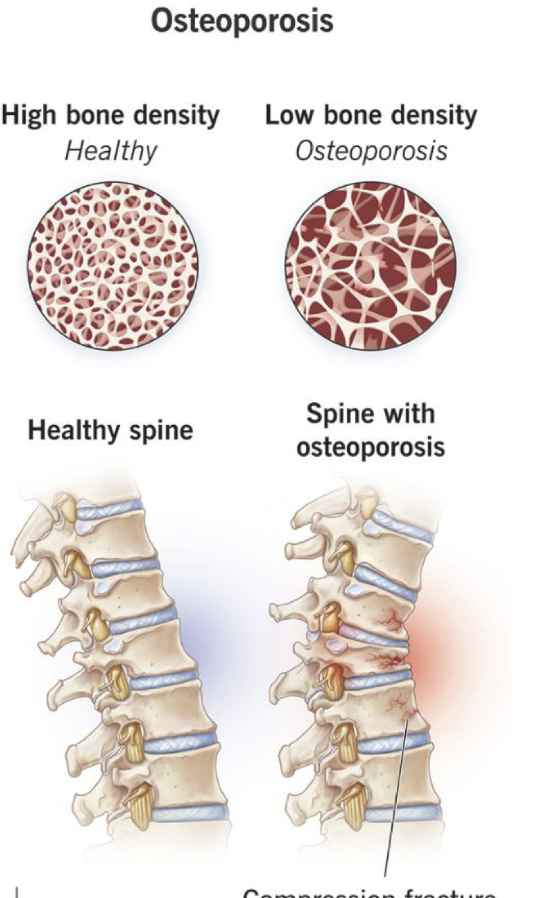 <p> = disease that weakens bones</p><p>characterized by low bone mass &amp; deterioration of bone tissue</p><ul><li><p>inc risk of fractures:</p></li><li><p>○ Hip</p><p>○ Spine</p><p>○ Wrist</p><p>○ Shoulder</p></li></ul><p></p>