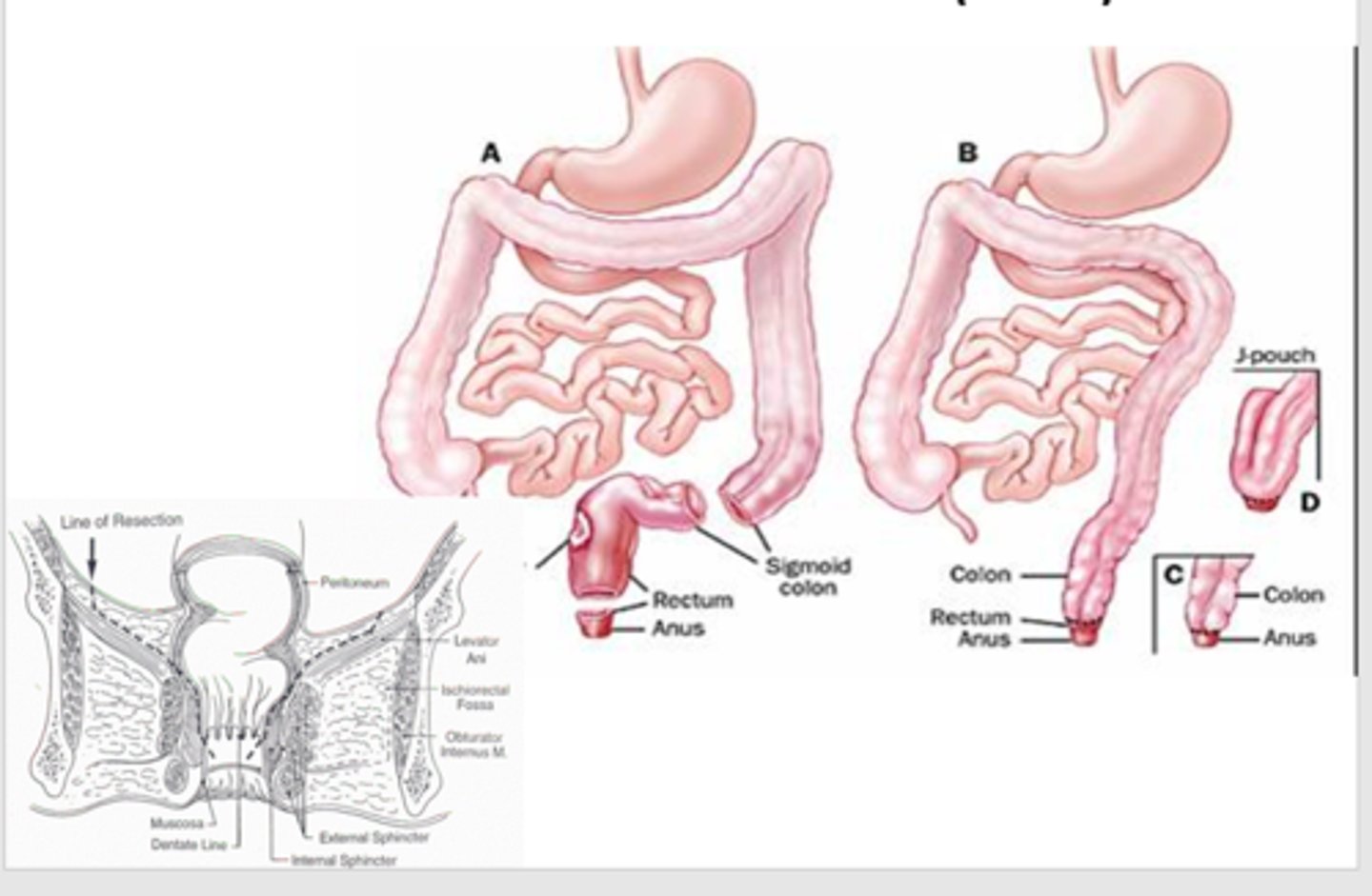 <p>Removal of tumour plus a margin and adjacent lymph nodes. The bowel is re-anastomosed, so a colostomy is not necessary.</p><p>Used in colon and upper and middle rectal cancers</p>