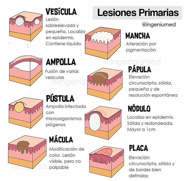 <p>Ampolla infectada con microorganismos piógenos.</p>