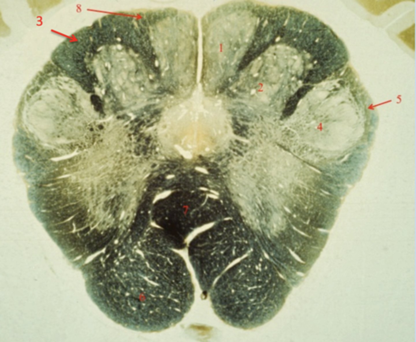 <p>spinal trigeminal nucleus</p>