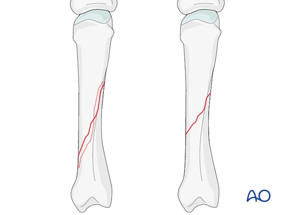 <p>What type of fracture is this?</p>