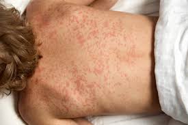 <ul><li><p>Hypersensitivity reactions <span data-name="sneezing" data-type="emoji">🤧</span> (rash, anaphylaxis)</p></li><li><p>Jarisch–Herxheimer reaction <span data-name="boom" data-type="emoji">💥</span> (seen in syphilis treatment)</p></li></ul><p></p><p><span>What causes the Jarisch–Herxheimer reaction?</span><br><strong>A:</strong><span> Rapid lysis of spirochetes (</span><em>Treponema pallidum</em><span>) after penicillin treatment </span><span data-name="cyclone" data-type="emoji">🌀</span></p><p></p>