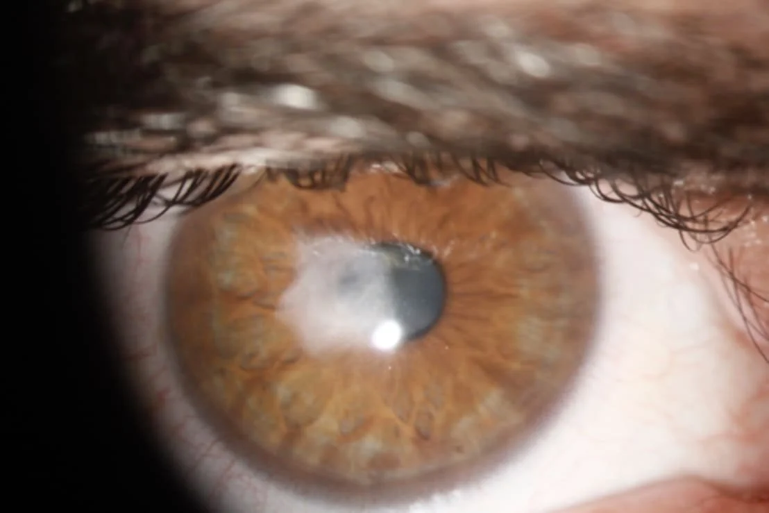 <p>appears greyis white, may be due to inflammation or an old injury</p>