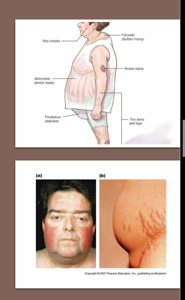 <p>Cushing’s Syndrome:</p><ul><li><p>Long-term use of what?</p><ul><li><p>What medication to use for Anti-Inflammation?</p><ul><li><p>Name of Drug?</p></li></ul></li><li><p>Less commonly, </p><ul><li><p>___ ___ is used for Joint Pain </p></li><li><p>___ for Eczema </p></li></ul></li></ul></li></ul><p></p>