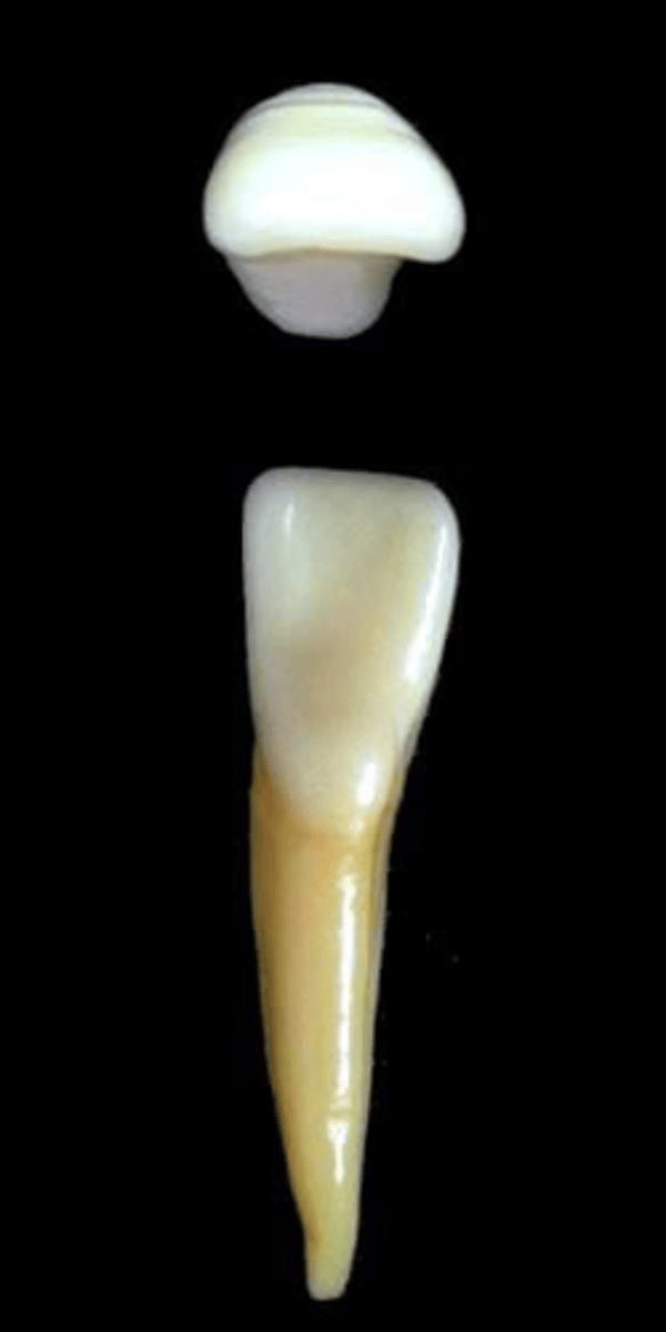 <p>what tooth is this &amp; why?</p>