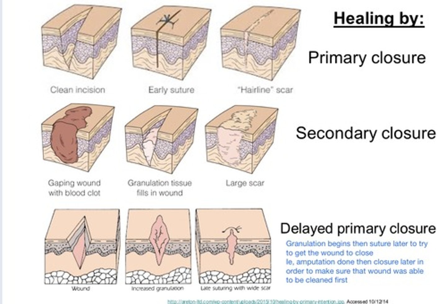 <p>1) Primary - epithelialization, connective tissue repair</p><p>2) Secondary - contraction, epithelilialzation</p><p>3) Tertiary - contraction, connective tissue repair</p>