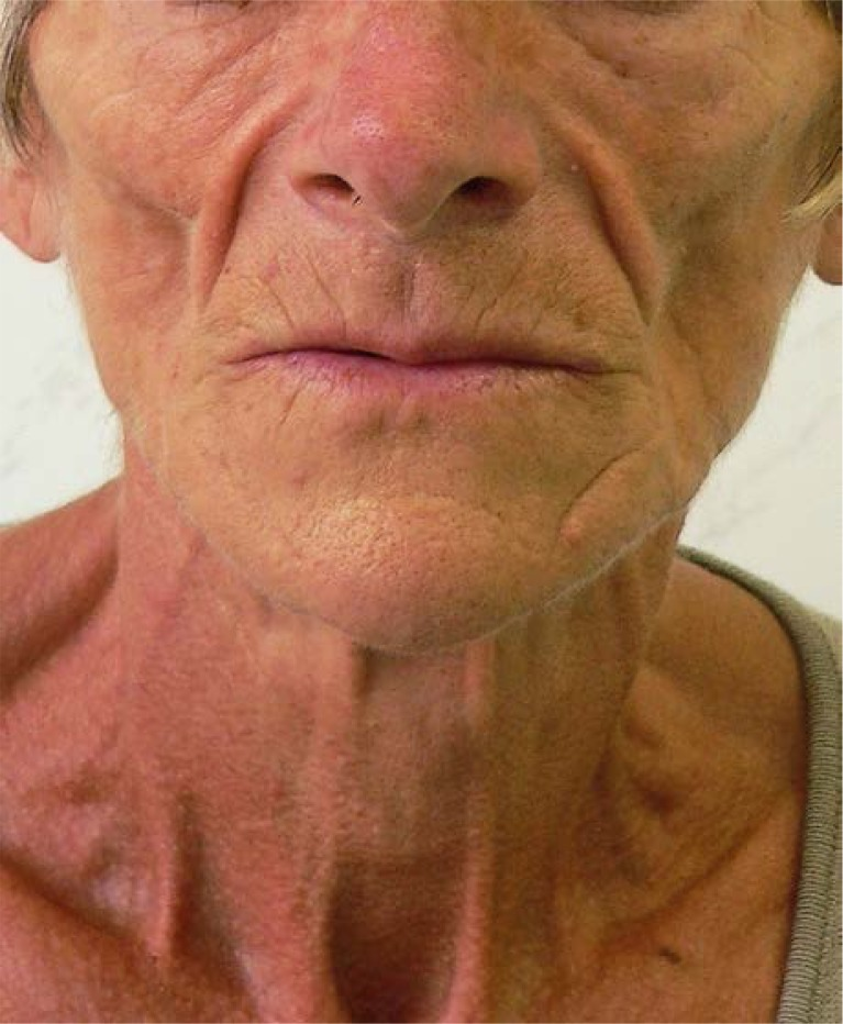 <p>def. atrophy in adipose tissues (as a result of <strong>oblique incidenc</strong>e)</p><p>FYI: "When treating H&amp;N with lateral fields that extend under the jaw and chin, due to the skin being thin in that area, it receives a higher dose, often leading to fibrosis and thickening resembling a rooster’s comb</p>