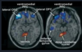 <p>activated - deep cerebellar nuclei</p><p>inhibited - orbitofrontal cortex</p>