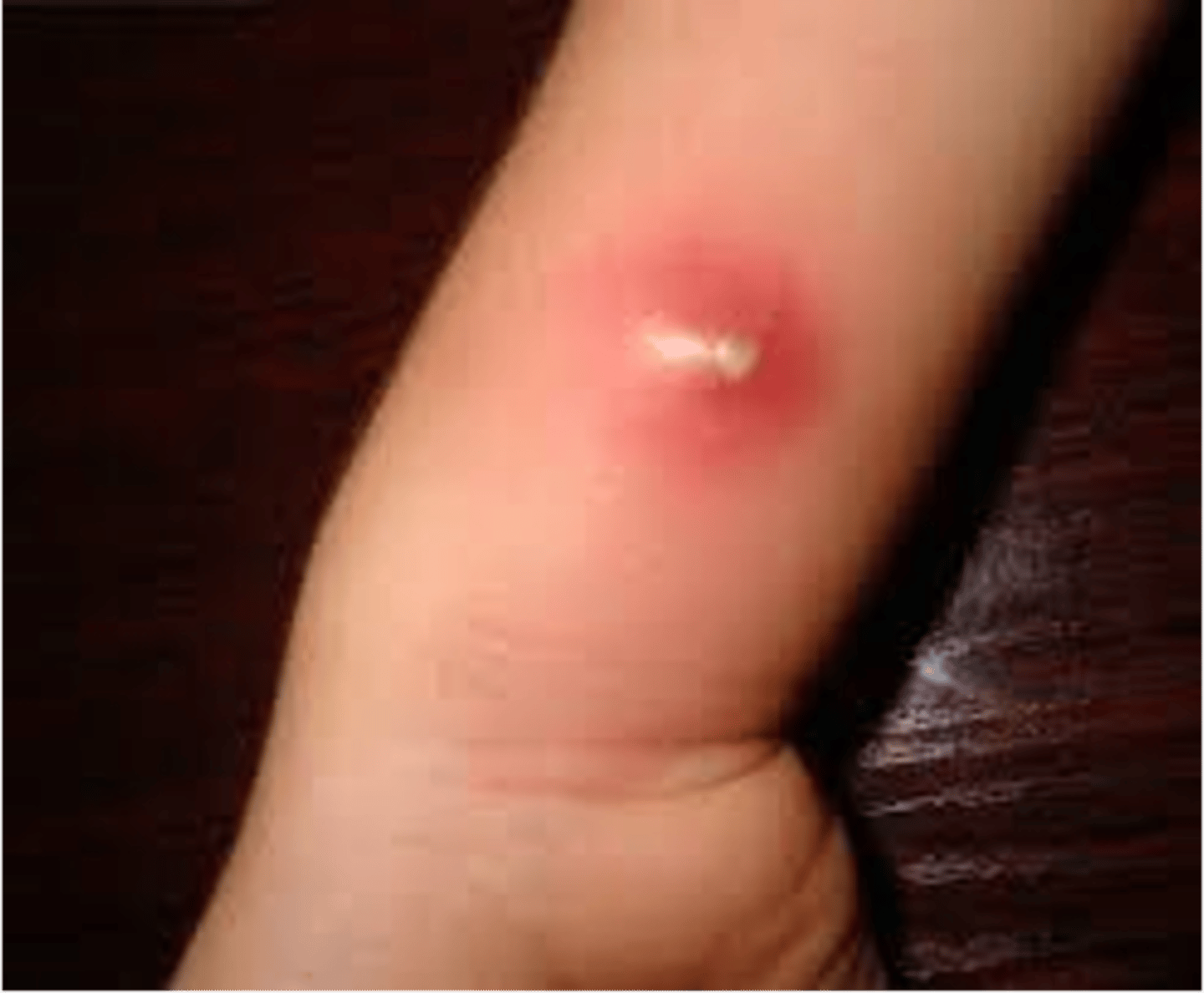 <p>name this skin pathology</p>