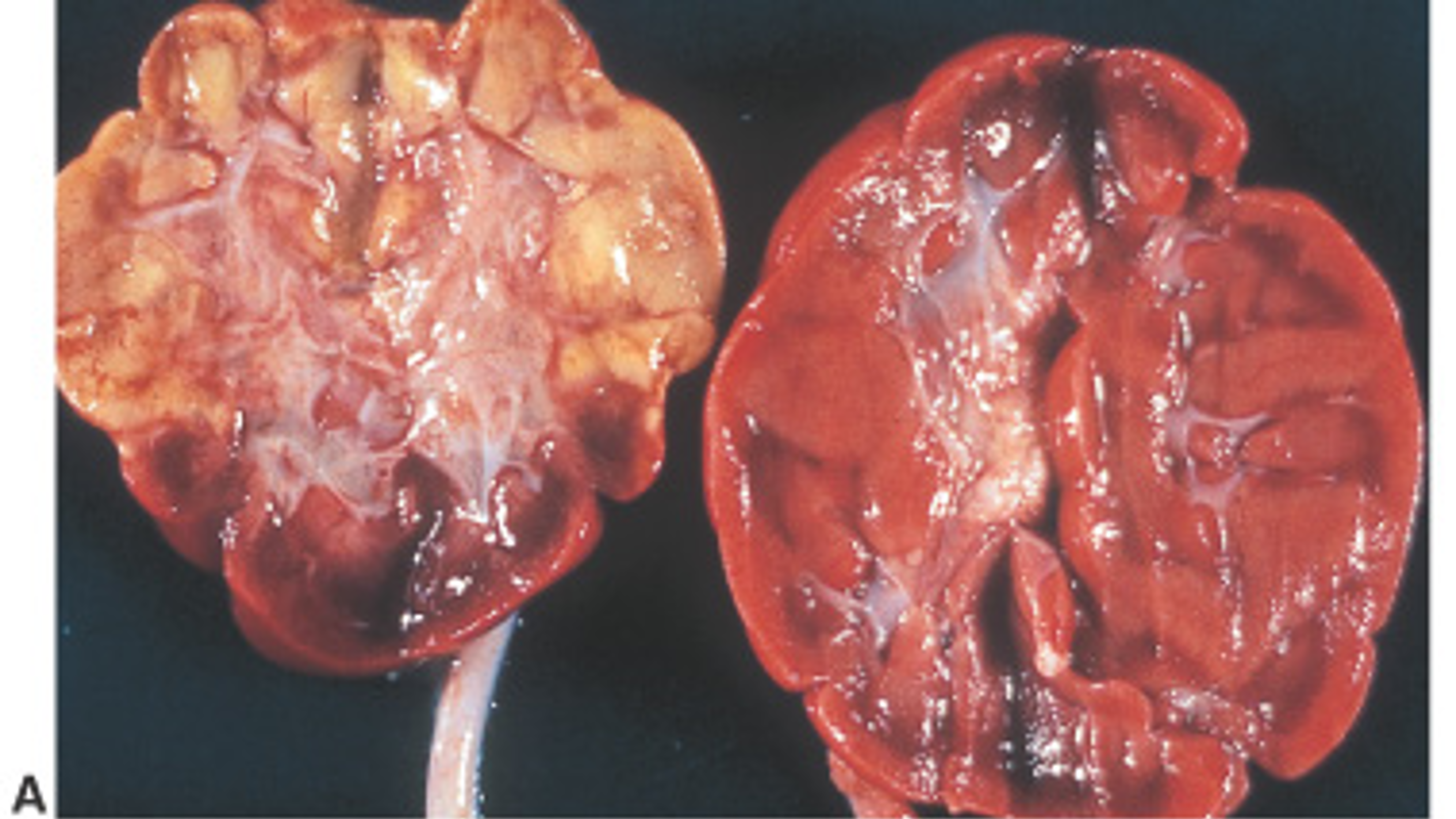 what type of necrosis is this?
