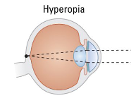 <p>aka. Farsightedness.</p><p>People cannot focus on <u>nearby</u> objects, because the focal point of light falls <em>beyond </em>the retina.</p><ul><li><p>The eyeball is too short. Can also be caused by the lens being too flat to refract adequately. </p></li></ul><p></p>