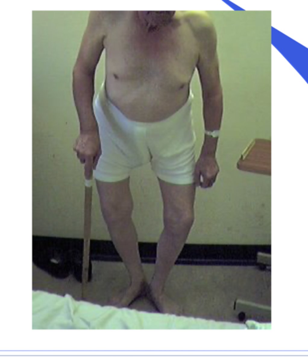 <p>Osteitis Deformans</p><p>- Abnormal collagen creating abnormal bone</p><p>- bowing of legs</p><p>- Hat and dentures may no longer fit</p>