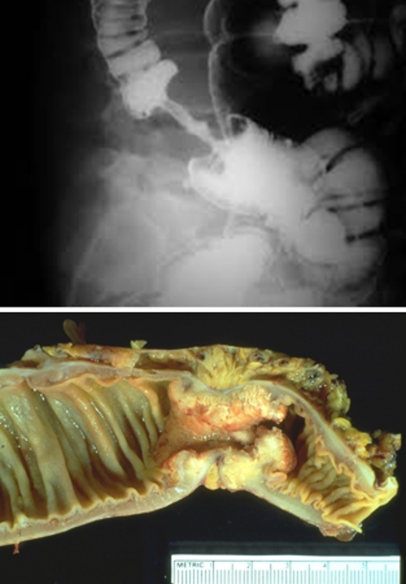 <p>apple core lesion or napkin-ring appearnce casuesd by narrowing of the lumen</p>