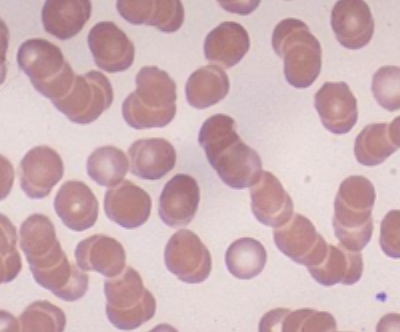 <p>Diagnostics for Multiple Myeloma</p>