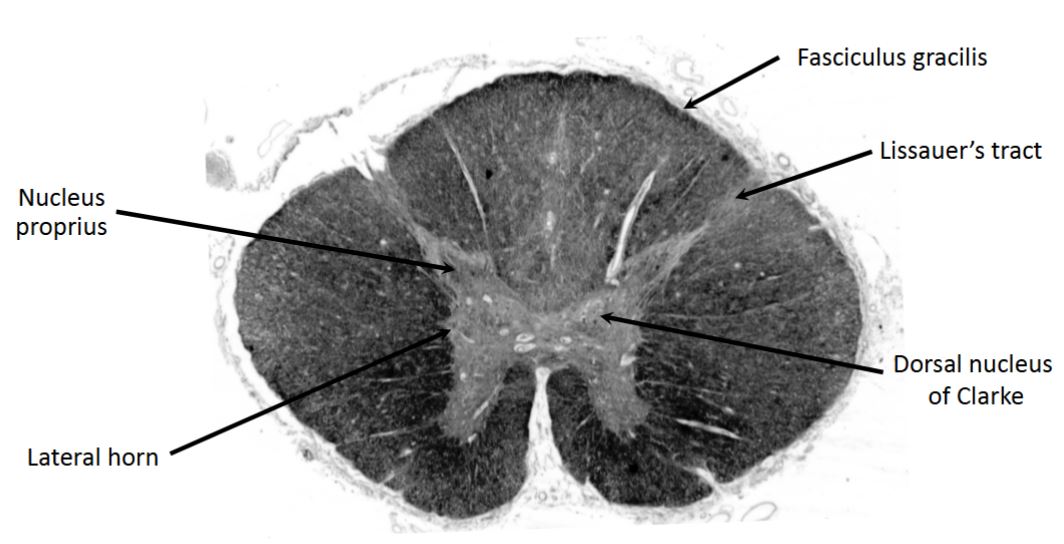 <p>lower thoracic (T11)</p>