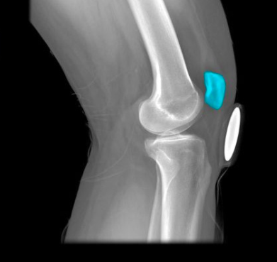 kneecap