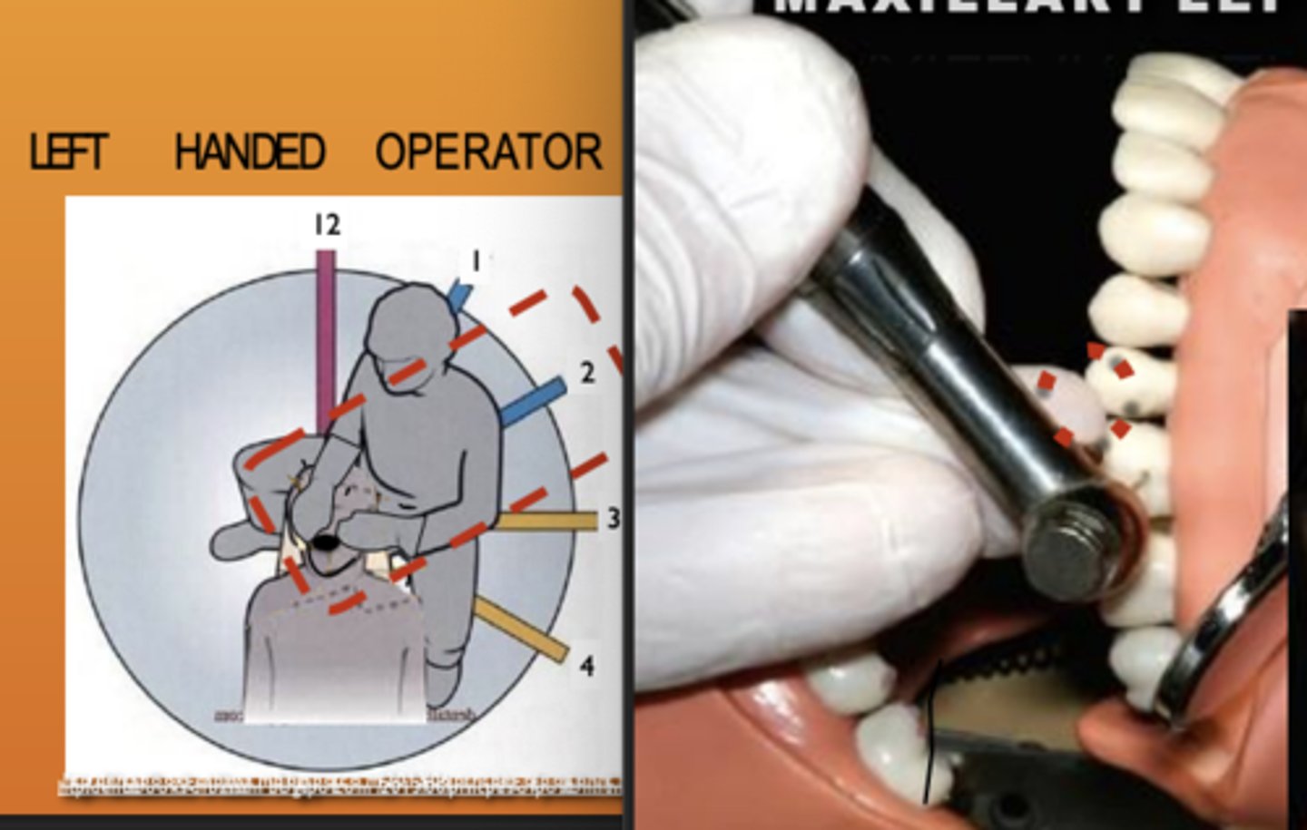<p>Zone: 2</p><p>Vision: direct</p><p>Patient's Head: right</p><p>Fulcrum: Max anteriors (I) / Man posterior (L)</p>