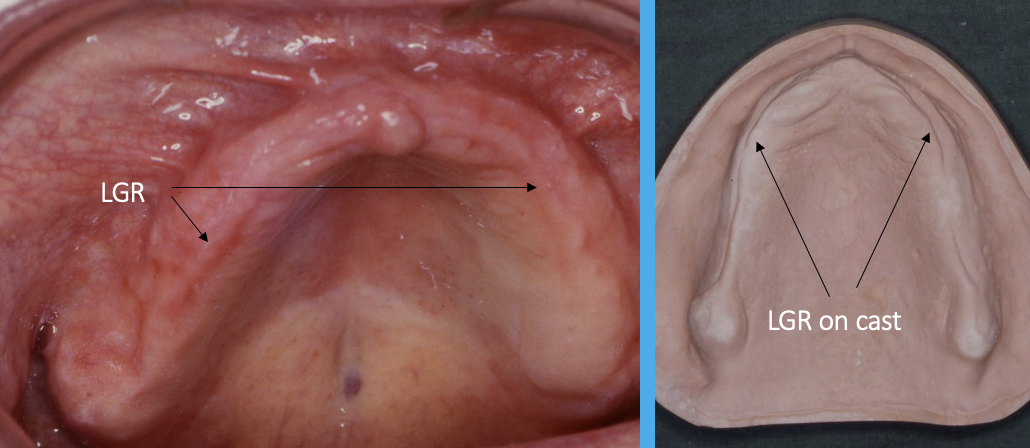 <ul><li><p>not seen in every patient, more commonly in newly edentulous patients</p></li></ul><p></p>