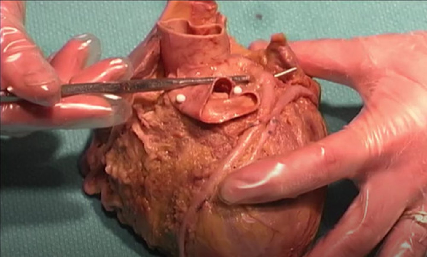 <p>What is this structure just above the metal pointer?</p><p>right coronary vein</p><p>left coronary vein</p><p>right coronary artery</p><p>left coronary artery</p>