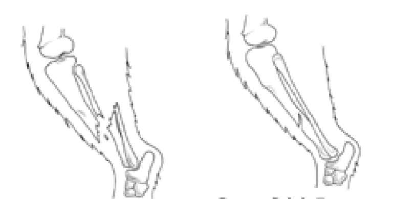 <p>fractures can be what?</p>