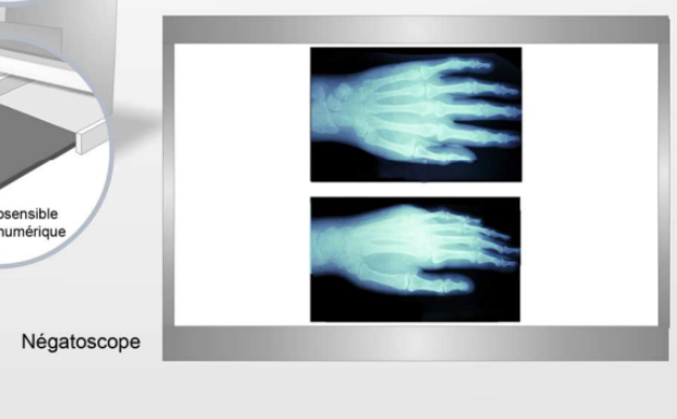 <p>La radiographie est une <strong>image en 2D</strong>. Ce qu'on voit, c’est une image avec un <strong>négatoscope</strong> : Si on met une main, normalement les rayons ne traversent pas là où il y a la main car ils ne traversent pas l’os donc la main est censée apparaître en noir. Mais une image radiologique est en fait une <strong>image en contraste inversé</strong>.</p><p>Donc ce qui apparait :</p><p>Blanc = Rayonnements qui ont été atténués</p><p>Noir = Rayonnement qui n’a pas été arrêté</p>
