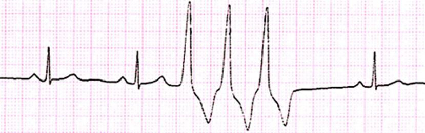 <p>Three consecutive premature beats </p>