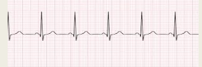 All measurements are within normal limits

The rate is between 60 – 100 bpm

There is a P wave indicating that the rhythm started in the SA node (sinus)