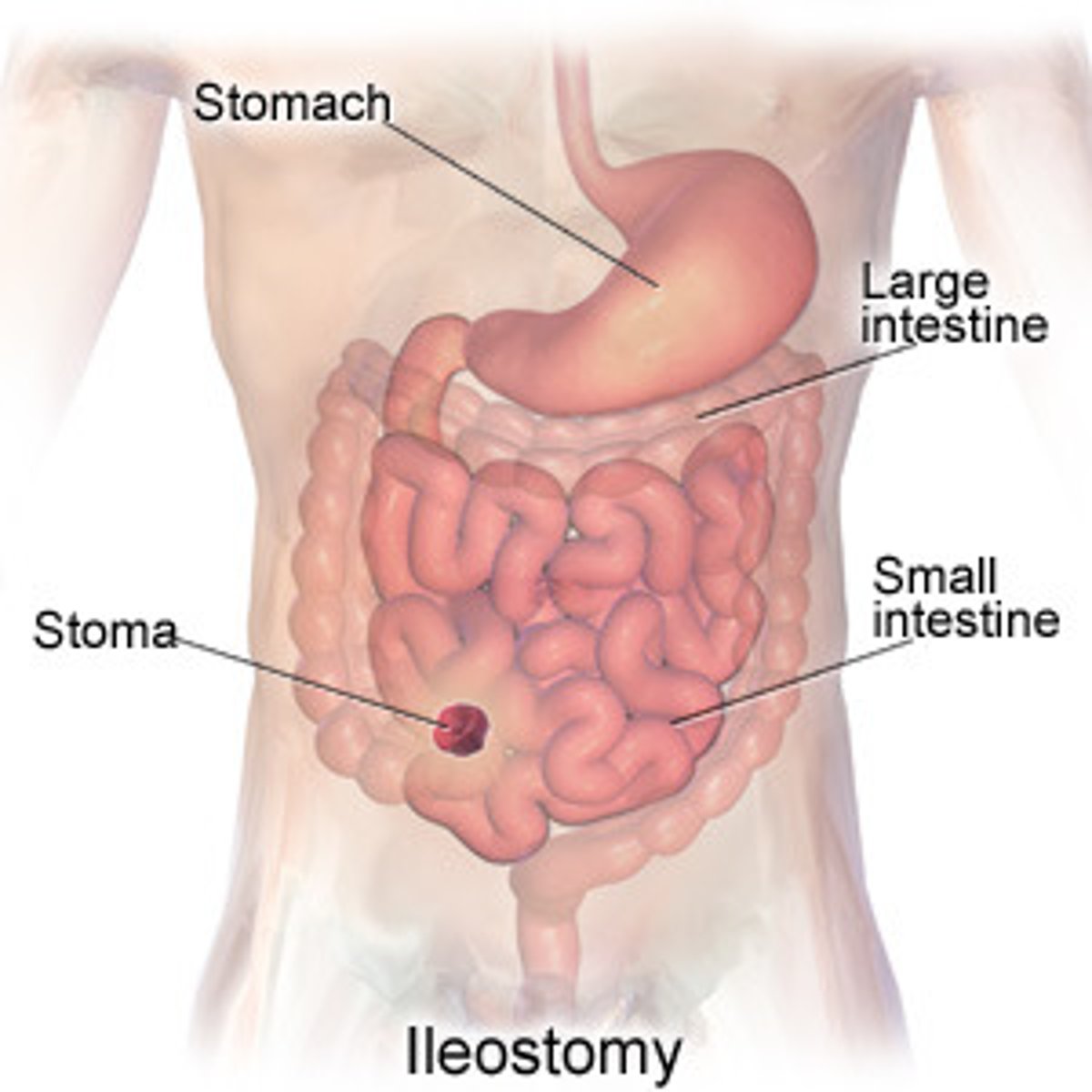 <p>the surgical creation of an artificial excretory opening between the ileum, at the end of the small intestine, and the outside of the abdominal wall</p>