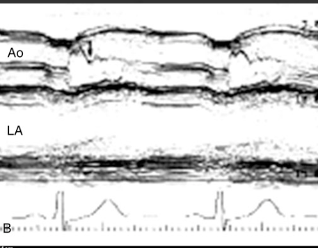 <p>What condition is seen in this 2D image?</p><p>What condition is it seen in?</p>