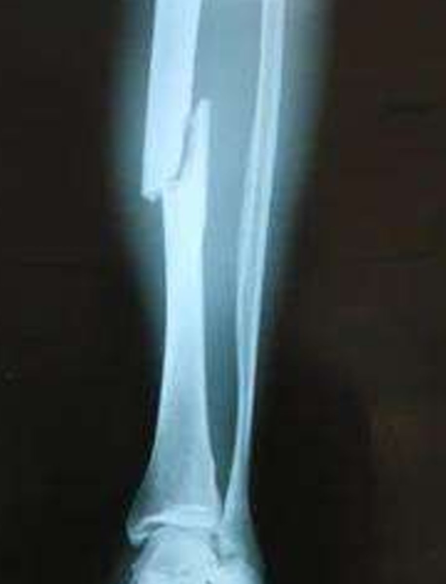 <p>What type of fracture is this?</p>