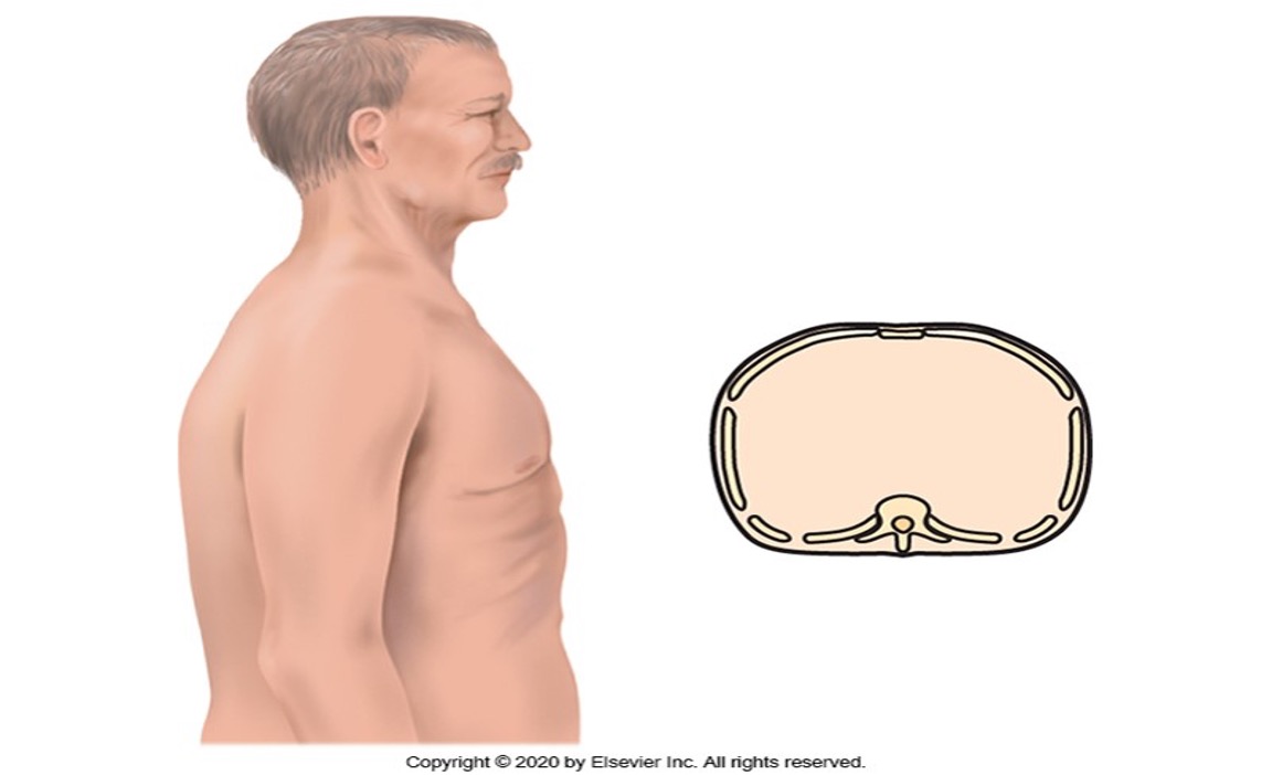 <p><span style="font-family: Arial">BARREL CHEST</span></p>