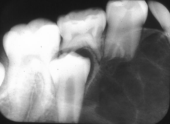 <p>Where would you find Central Giant Cell Granuloma (CGCG)?</p>