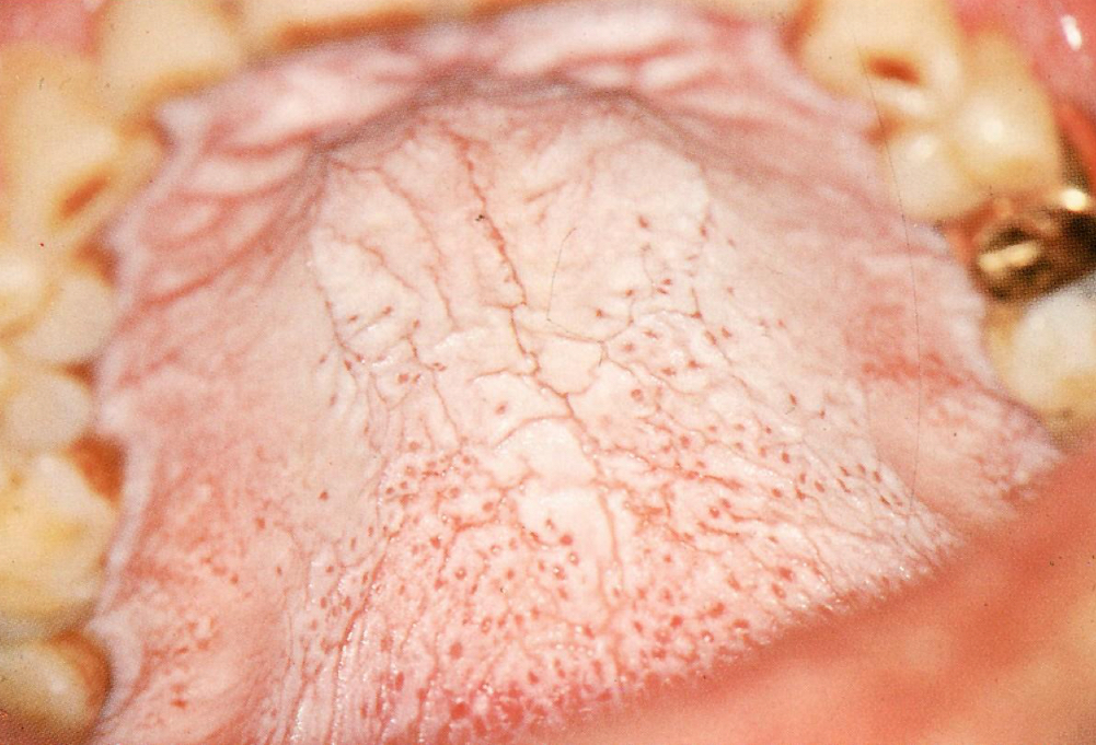 <p>Nicotine stomatitis </p>