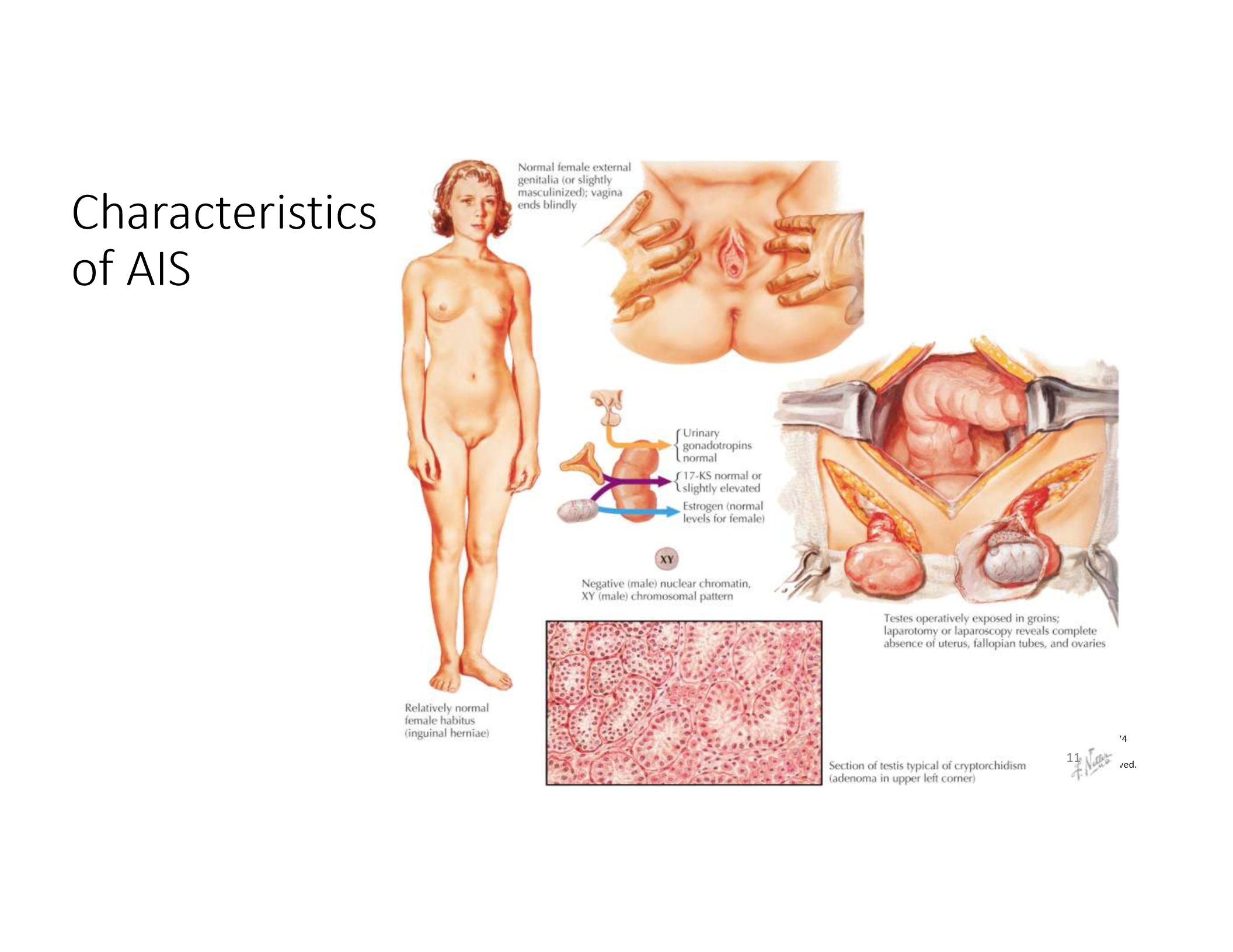 <p>Normal breast development, absent uterus/upper vagina, scant pubic/axillary hair, elevated testosterone and LH.</p>
