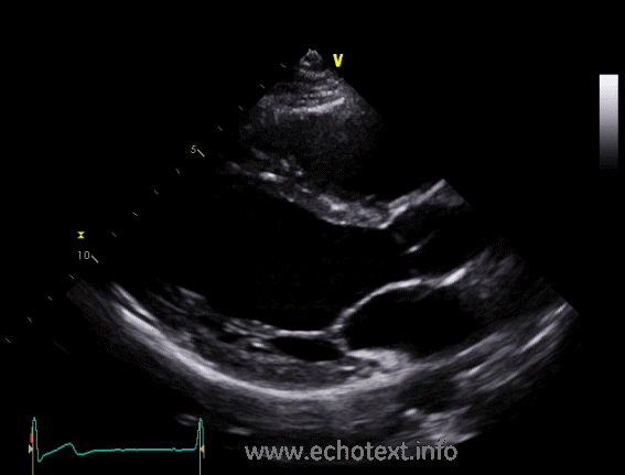 <p>Where is the transducer initially placed for obtaining the PSLA view?</p>