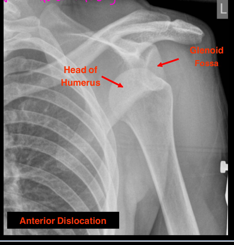 <p>What is clinical diagnosis of this dislocation?</p>