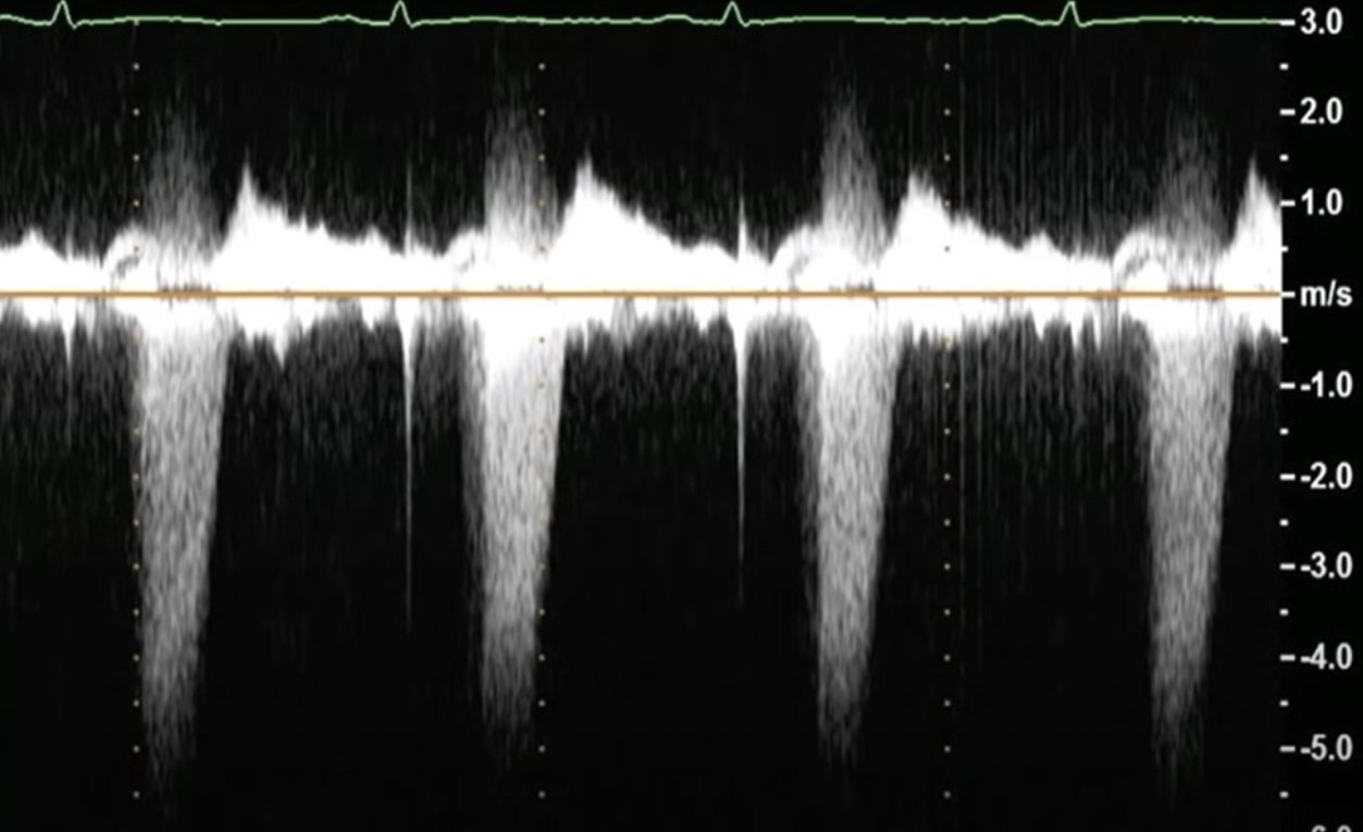 <p>Doppler waveform most suggestive of? </p>