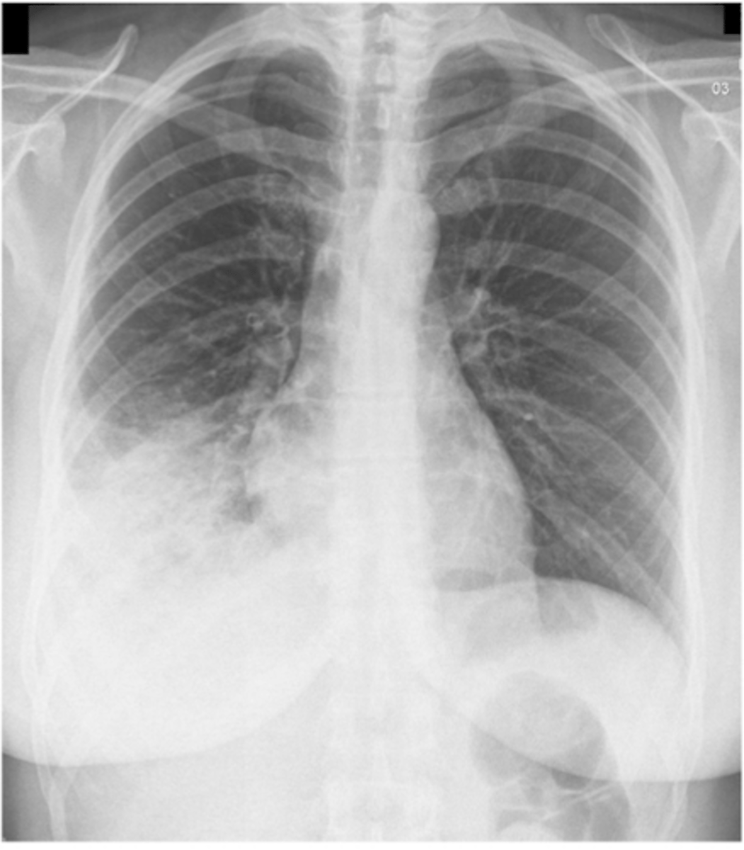 <p>What sign is present? What lobe is affected?</p>
